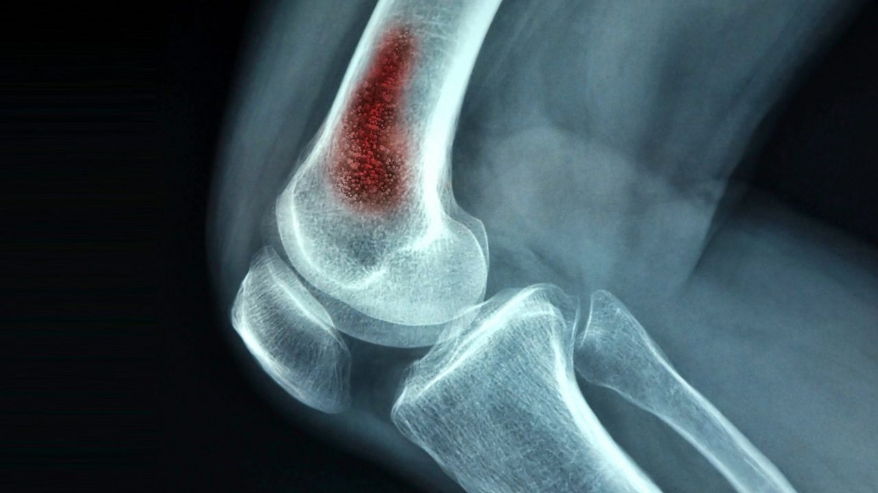 Osteomyelitis Market