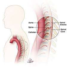 Spinal Angiography