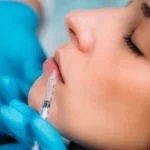 dermal-filler-for-lips