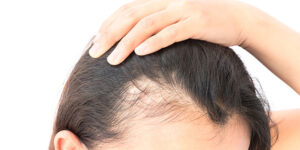 Fue hair transplant mumbai