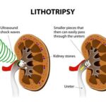 Lithotripsy Cost