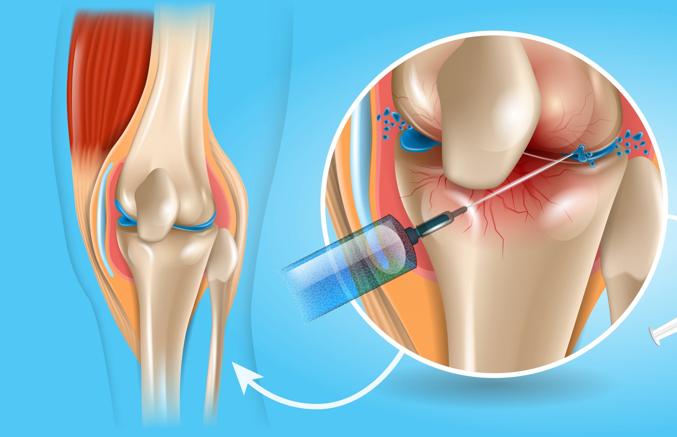 Osteoarthritis Therapeutics Market