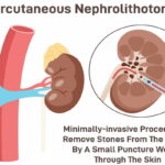 Percutaneous-Nephrolithotomy