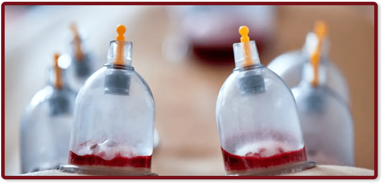 Traditional Hijama vs. Modern Hijama