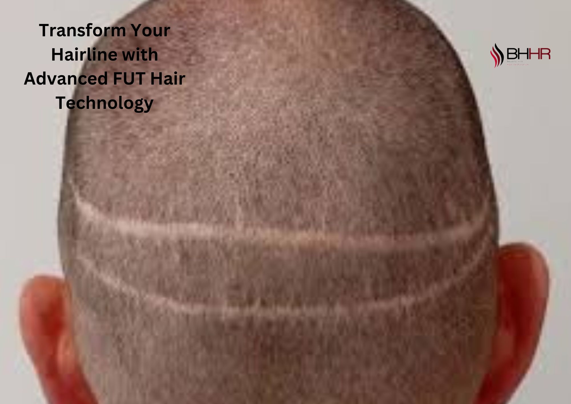 Transform Your Hairline with Advanced FUT Hair Technology