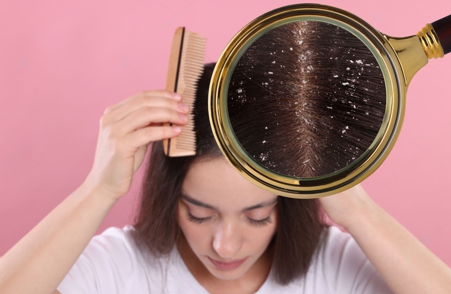 Dandruff Hair