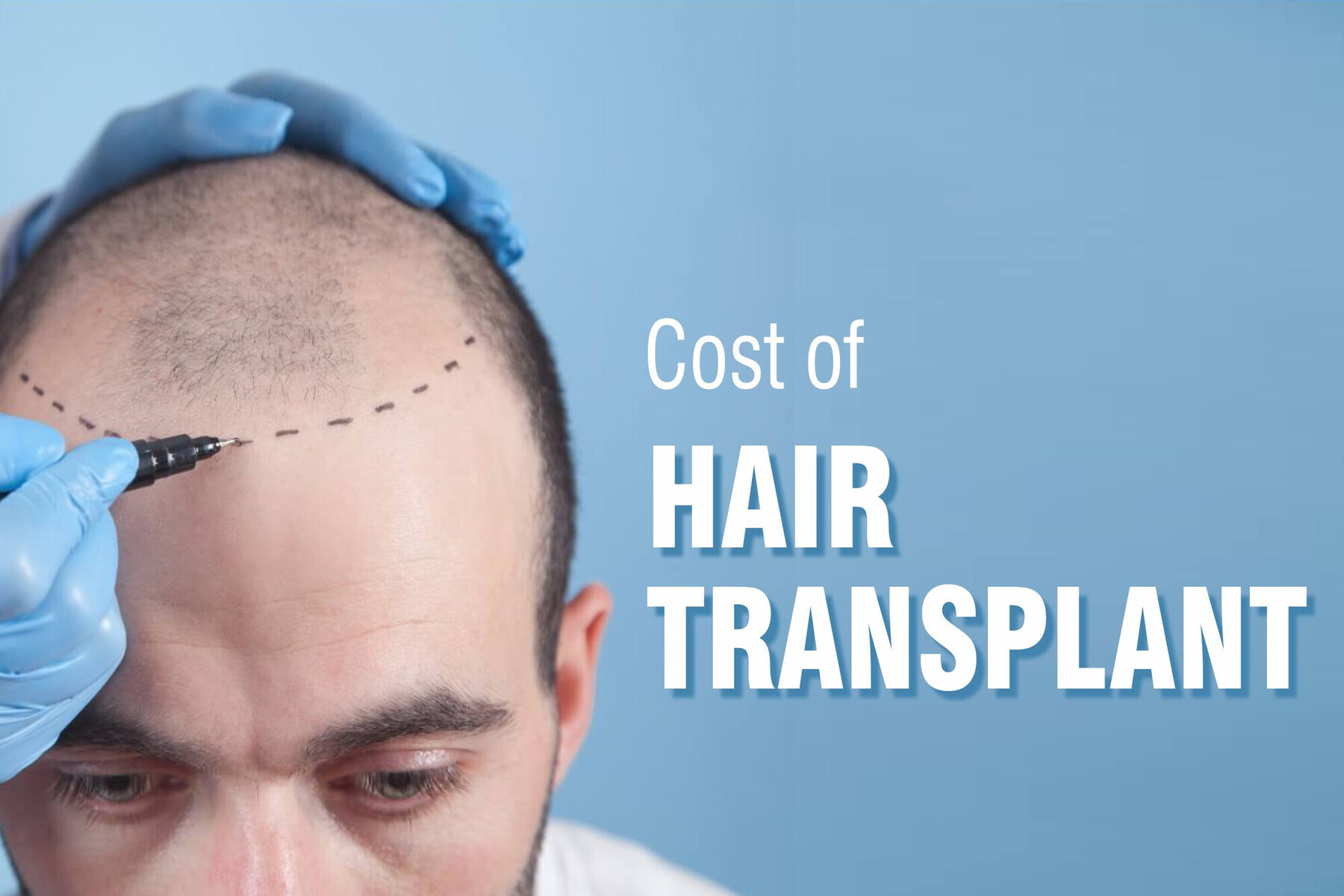 hair transplant cost (1)