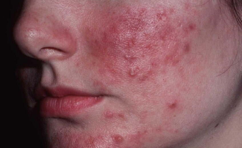 rosacea-848x518