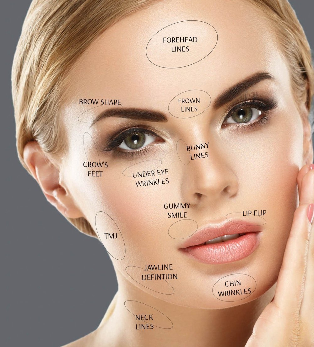 Areas-treated-with-botox-2