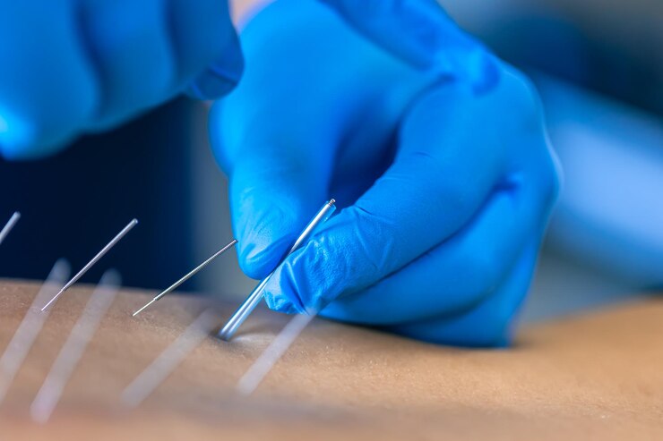 Dry Needling Therapy