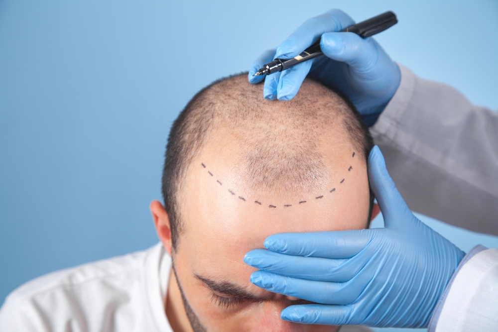 What to Expect Before and After Hair Transplant Surgery in Bathinda