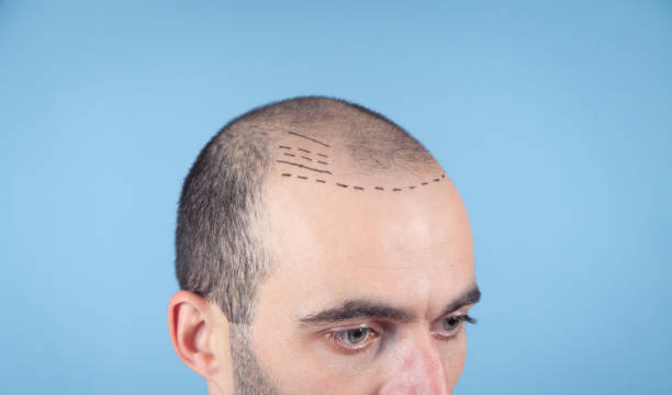 Hair Transplant in Karachi