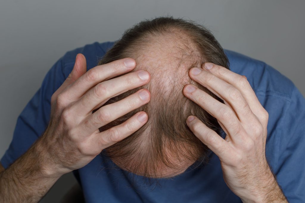 men hair thinning