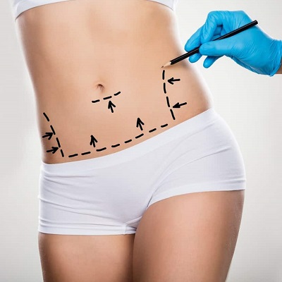 Tummy Tuck Surgery in Riyadh