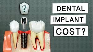 cost-of-dental-implant