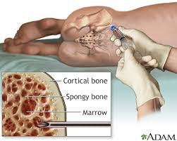 Bone Marrow Transplant Cost in India: A Comprehensive Guide