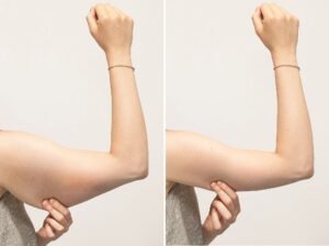 ARM LIFT TREATMENT IN ISLAMABAD