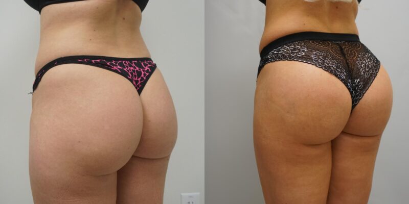 brazilian butt lift before and after