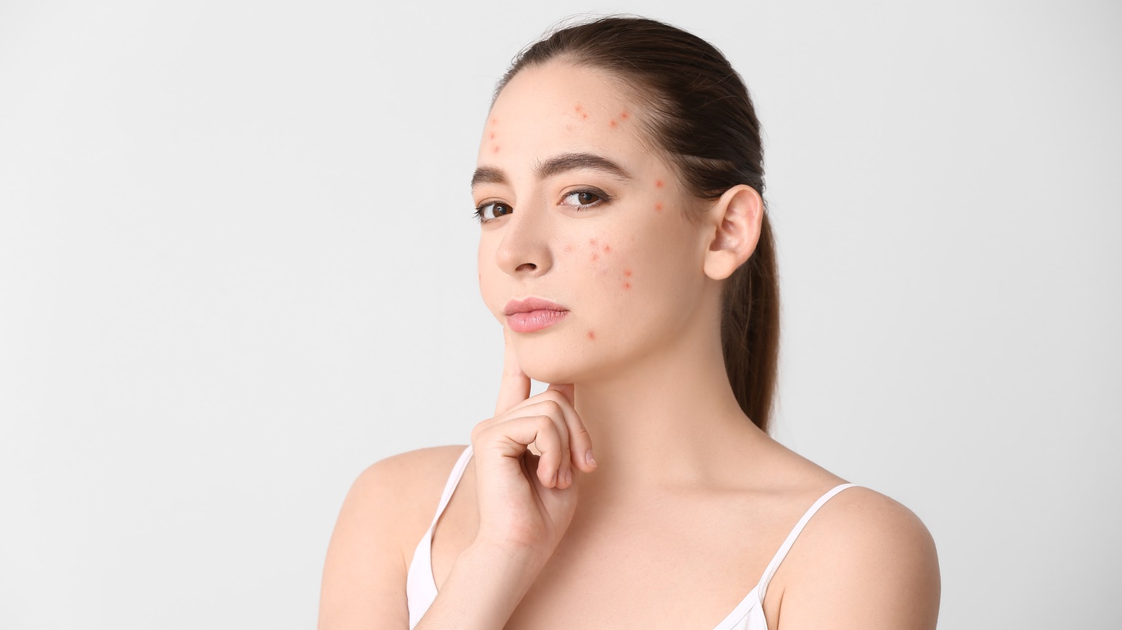 What does doxycycline 100mg do for acne?