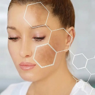 melasma treatment in Islamabad