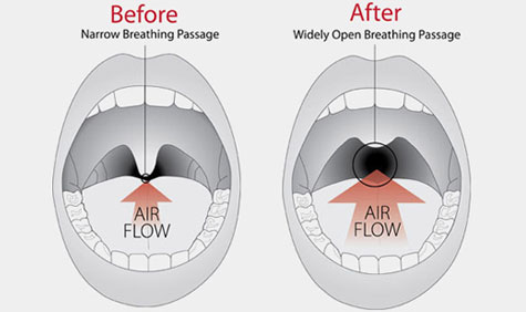 Snoring Treatment