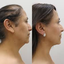 neck liposuction cost