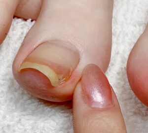 ingrown+toenail2