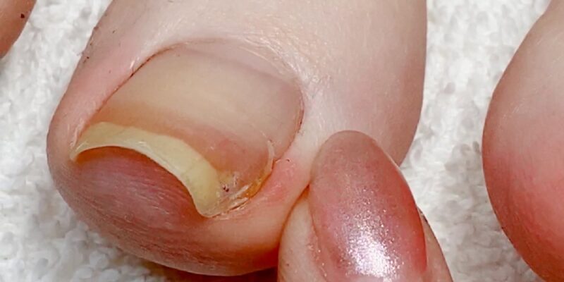 ingrown+toenail2