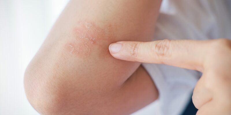 psoriasis clinical trial﻿