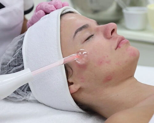 Acne-Treatment-Facial