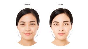 Masseter Botox