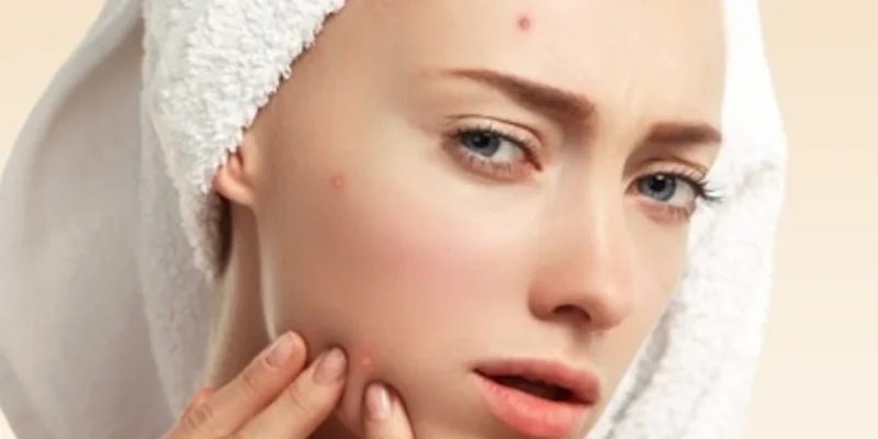 acne pimple spots