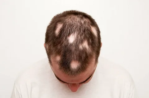 alopeciaareatatreatment