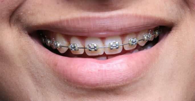 diamond braces