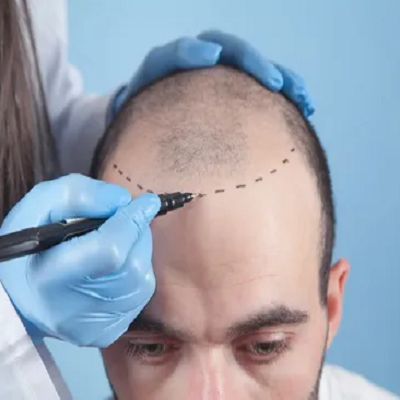 Everything You Need to Know About Hair Transplants