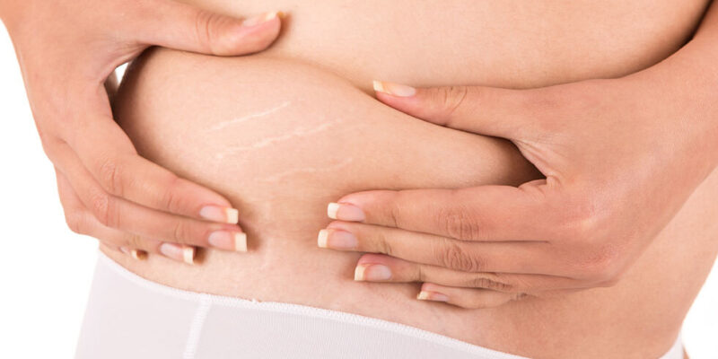 Laser Stretch Mark Removal Doctor in Guwahati