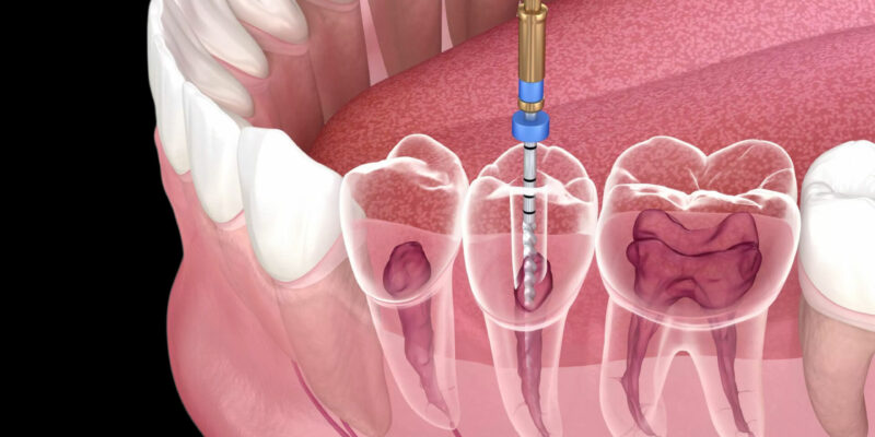 Root Canal Treatment in Islamabad