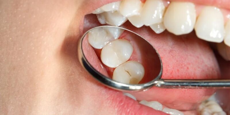 Sealants for Teeth