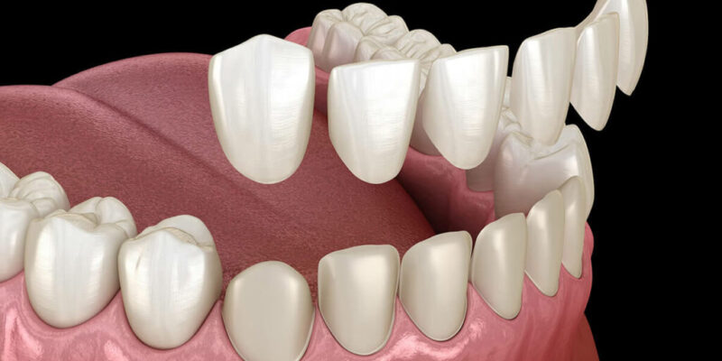 dental-veneers-dental-service-1024x768