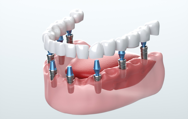 dental_implants_600