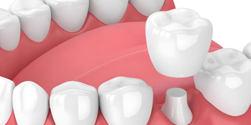 dentist crowns