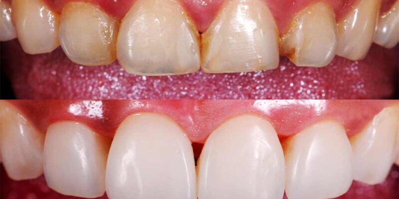 front teeth cavity fillings