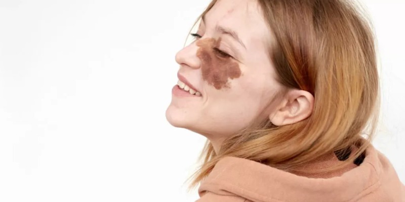 birthmark removal in Dubai