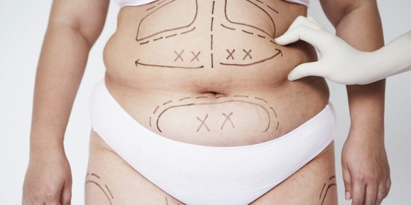 liposurgery