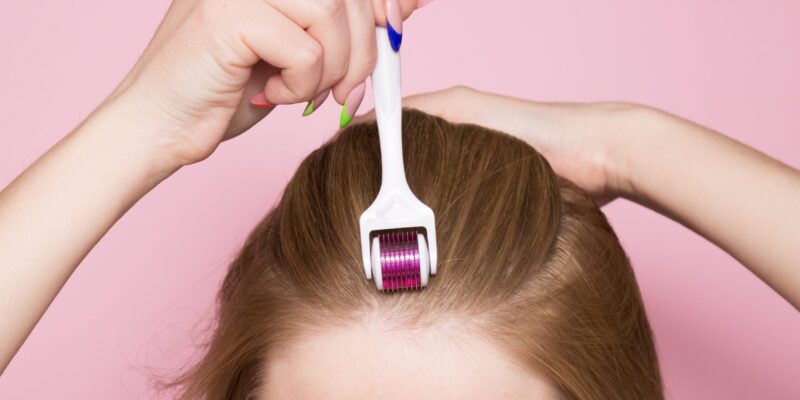 microneedling for hair loss