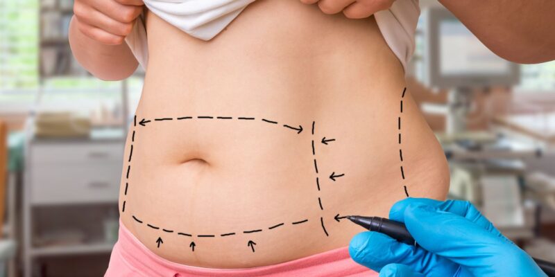 plastic-surgery-doctor-draw-lines-with-marker-on-patient-belly-618982296-511be18f48d34dd5bde23199f476d154