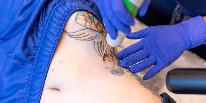 tatto removal in Dubai