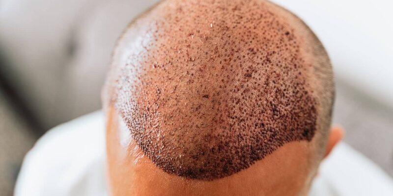 Hair-transplant-scabs