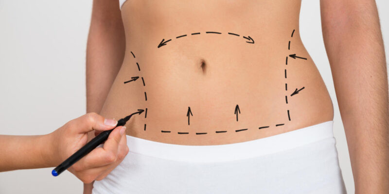 Liposuction surgery in Dubai (2)